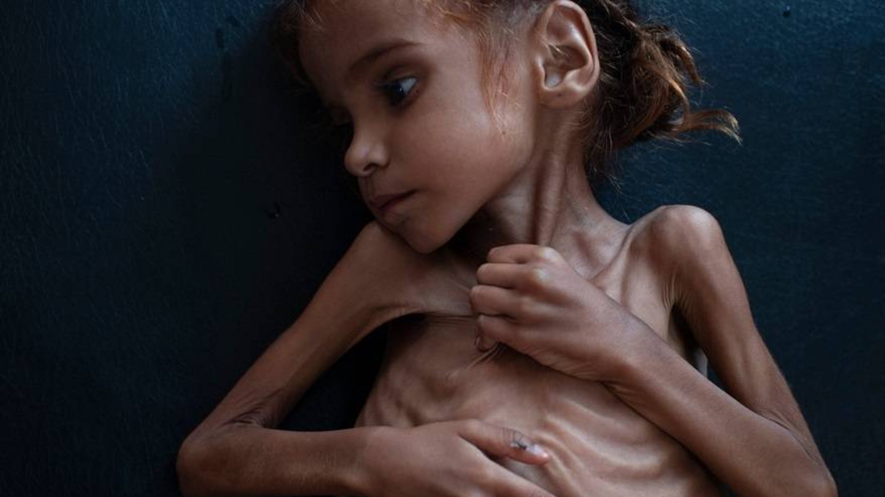 Why This Picture of a Girl Starving in Yemen Was One of the Most Important Photos of 2018